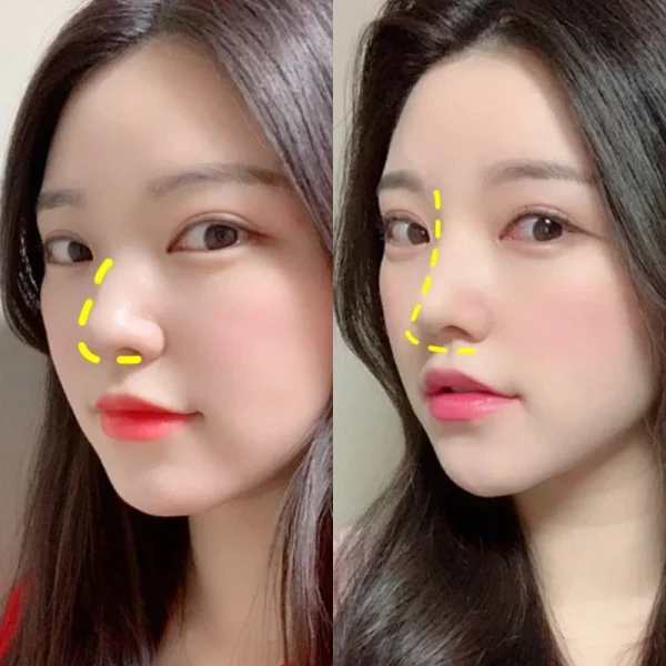 Nẹp Mũi Nhựa Nhiệt Dẻo - Giải Pháp Định Hình & Bảo Vệ Sống Mũi Hiệu Quả 2025 - Hình ảnh 2